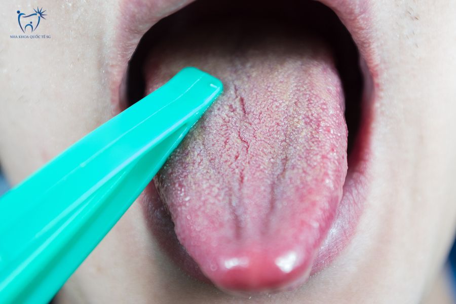 Nha Khoa Quốc Tế Sài Gòn Kiểm tra hôi miệng bằng cách cạo lưỡi