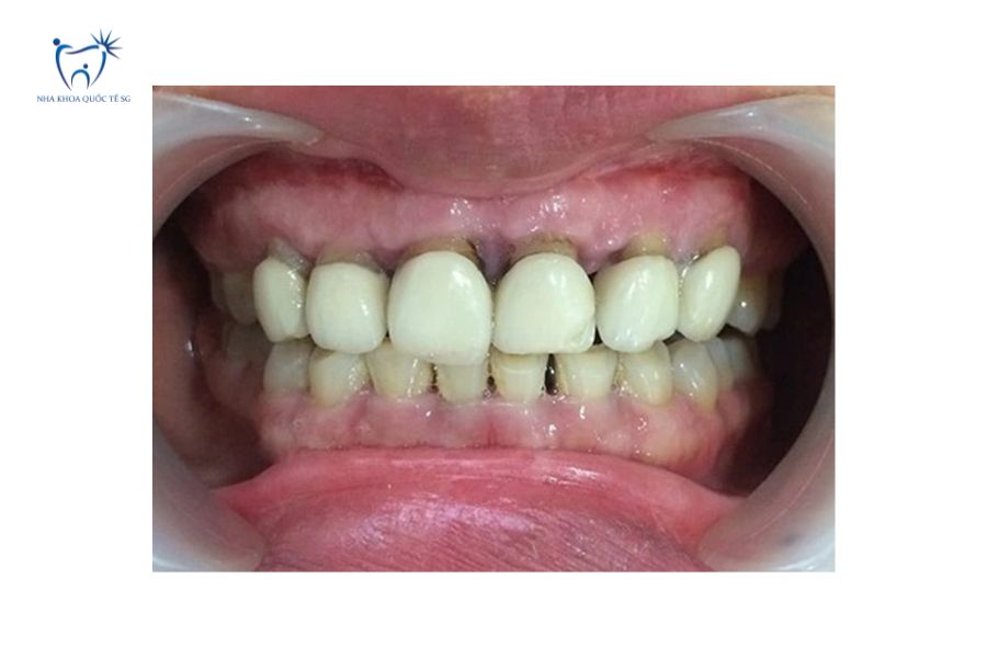 Tình trạng viêm chân răng bọc sứ cấp tính