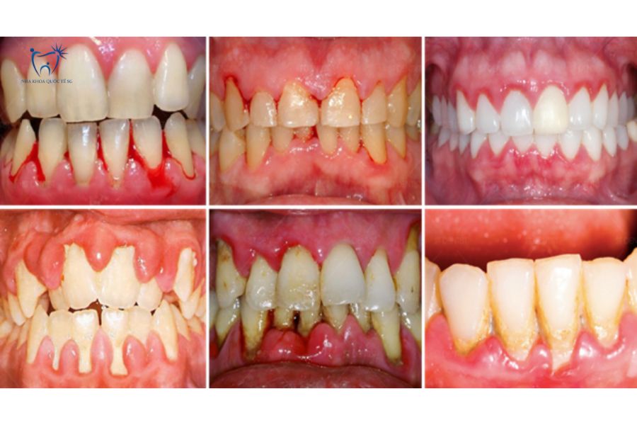 Một số hình ảnh về bệnh nha chu cần điều trị trước khi bọc sứ