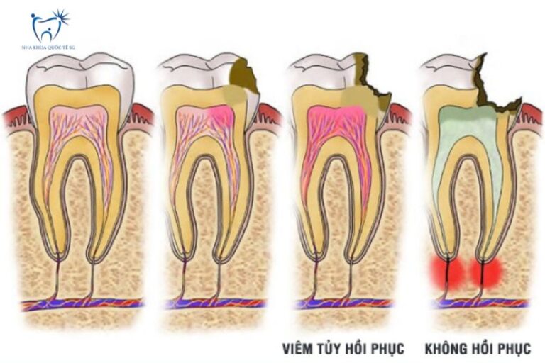 Viêm tủy hồi phục và viêm tủy không hồi phục