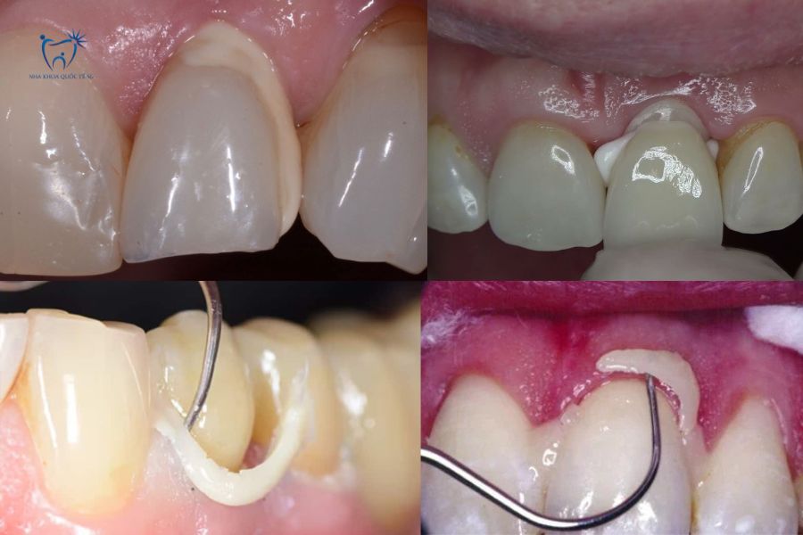 Xi măng gắn sứ bị dư thừa sau khi bọc sứ