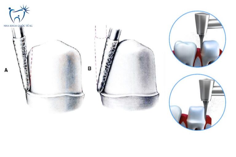 Mài nhỏ răng để bọc sứ hoặc dán veneer