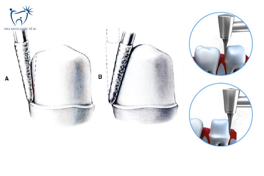 Mài nhỏ răng để bọc sứ hoặc dán veneer