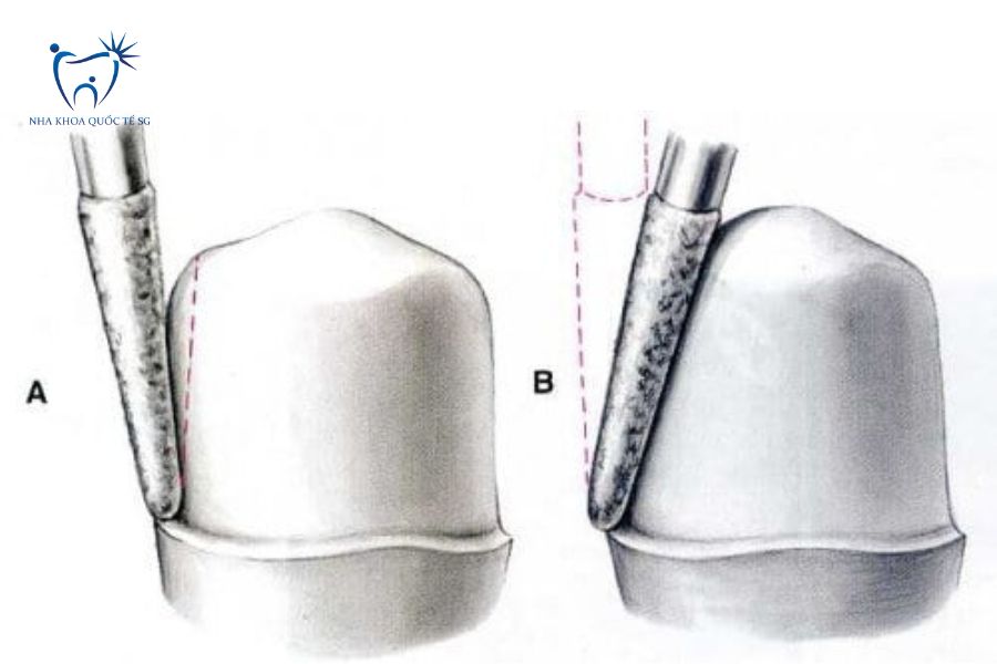 Nha Khoa Quốc Tế Sài Gòn Bác sĩ sử dụng dụng cụ chuyên dụng để mài nhỏ răng
