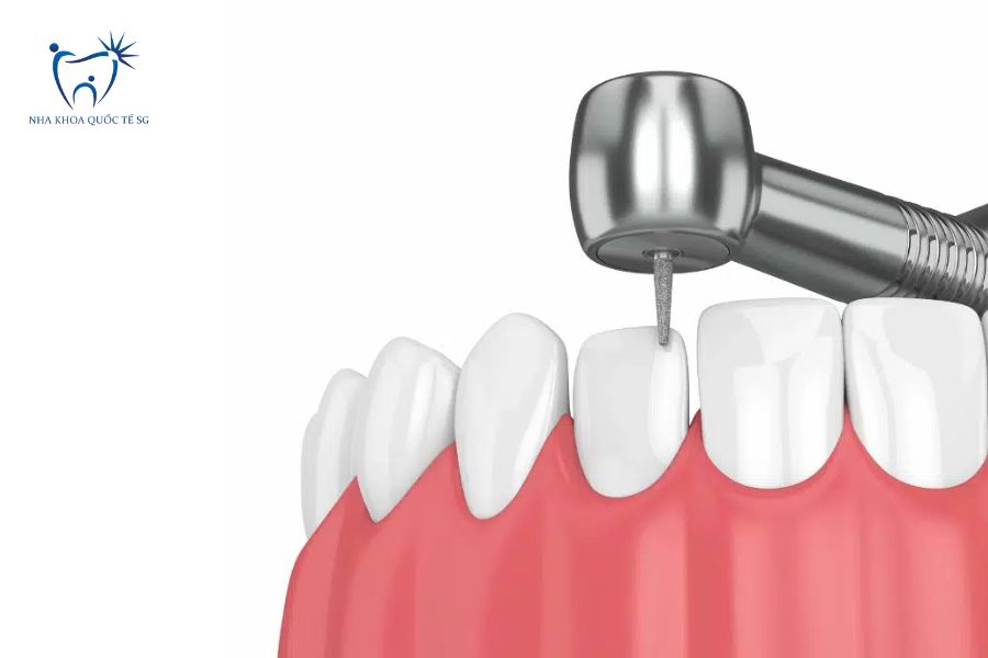 Nha Khoa Quốc Tế Sài Gòn Bác sĩ sử dụng dụng cụ chuyên dụng để mài nhỏ răng