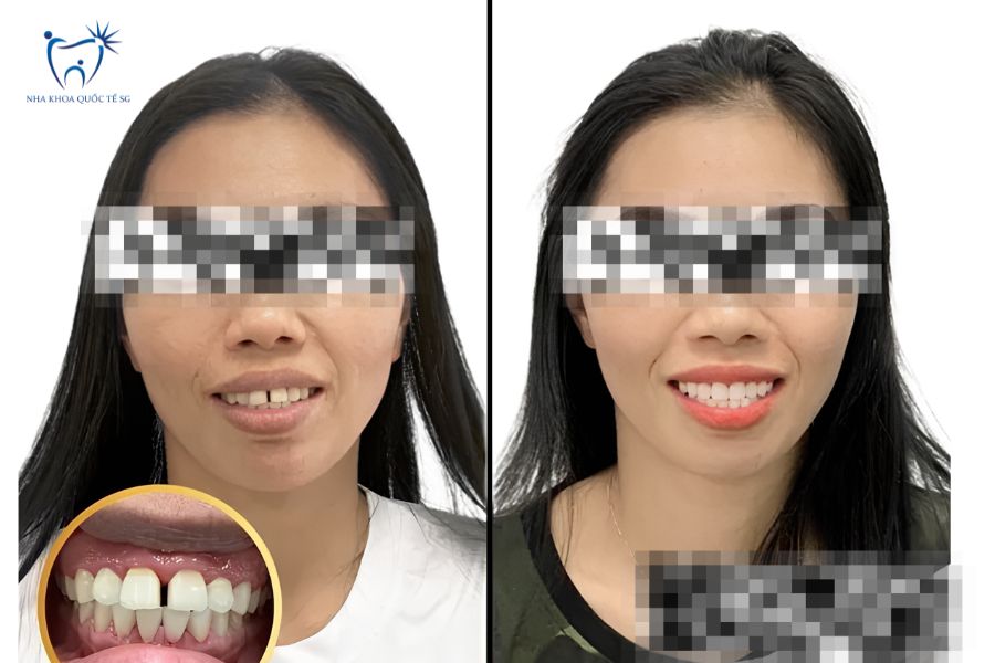 Trước và sau khi khách hàng bọc sứ răng cửa