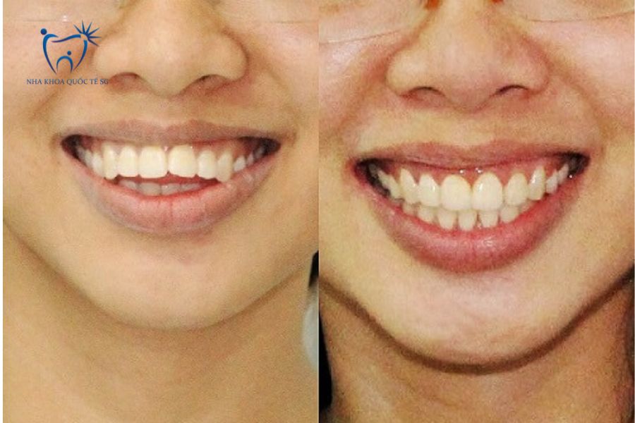 Bệnh nhân trước và sau khi bọc sứ răng cửa bị hô