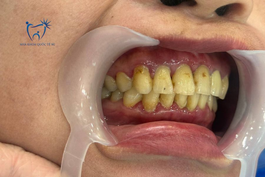 Bệnh nhân bị hô nhẹ thăm khám tại Nha Khoa Quốc Tế Sài Gòn