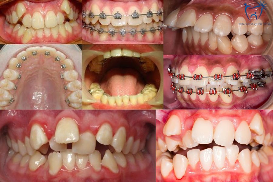 Khách hàng có răng khểnh nhẹ trước và sau khi bọc sứ