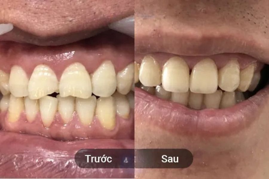 Khách hàng bị mẻ răng cửa và bọc sứ để cải thiện