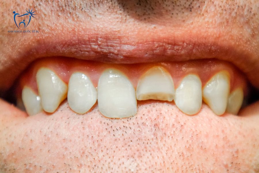 Răng cửa bị mẻ lớn nên bọc sứ
