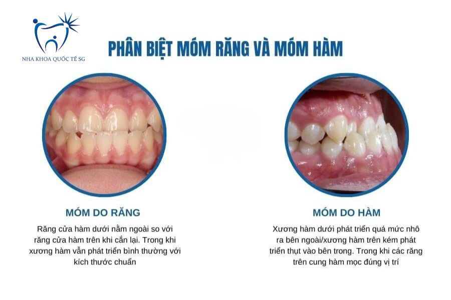 Nha Khoa Quốc Tế Sài Gòn So sánh các dạng móm răng khác nhau