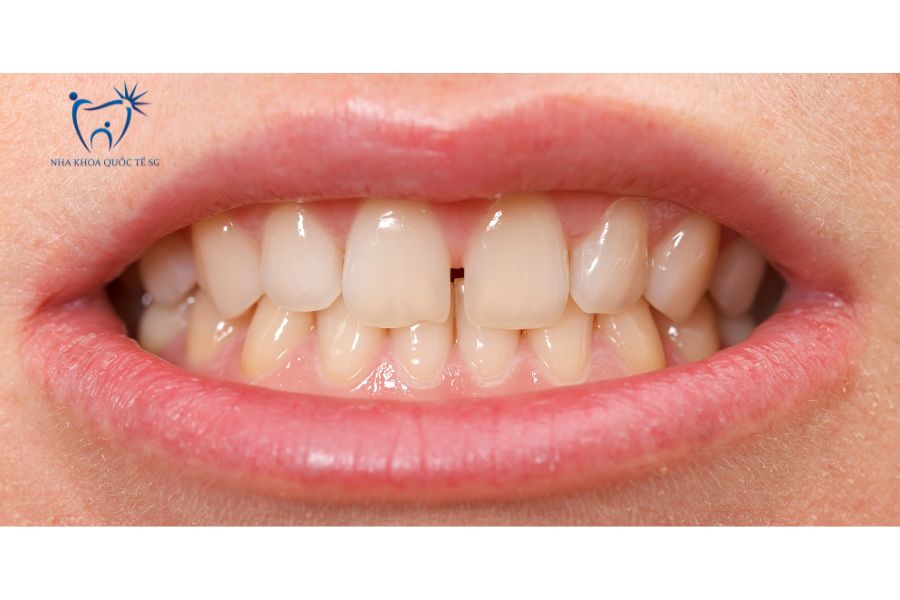 Khách hàng có tình trạng răng cửa bị thưa nhẹ