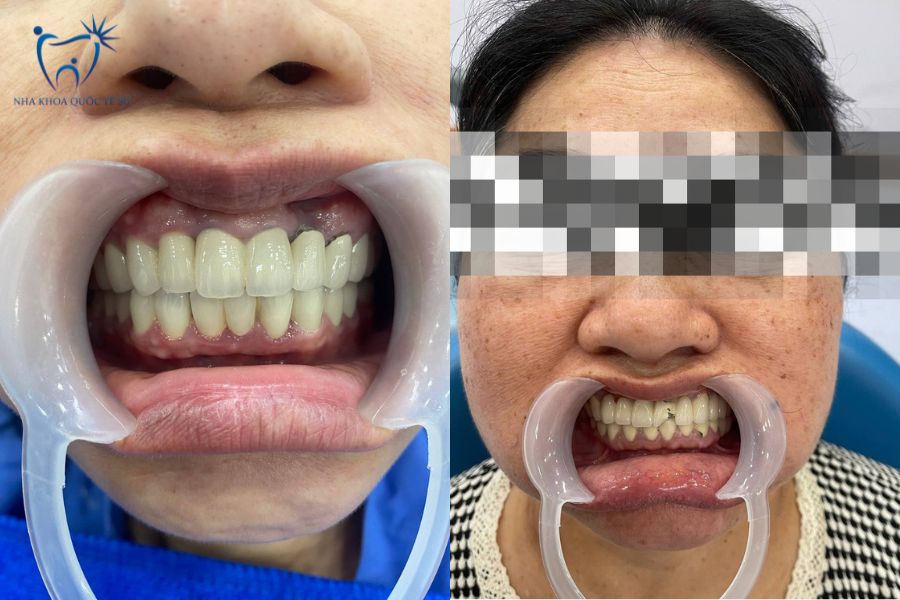 Bệnh nhân bọc răng bằng sứ kim loại dẫn đến đen viền nướu