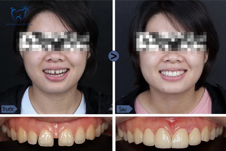 Hình ảnh khách hàng trước và sau khi dán sứ
