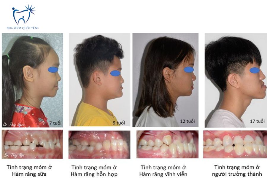 Nha Khoa Quốc Tế Sài Gòn Một số trường hợp khách hàng bị móm răng khác nhau