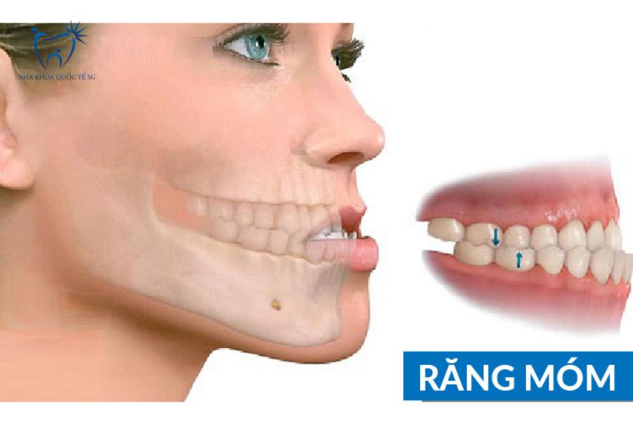 Hình ảnh minh họa tình trạng móm răng