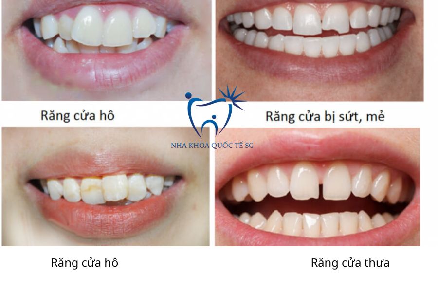 Những tình trạng nên bọc sứ răng cửa