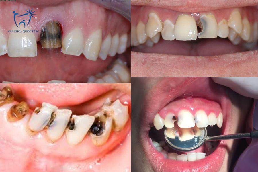 Nha Khoa Quốc Tế Sài Gòn Tình trạng răng cửa bị hư hỏng nặng