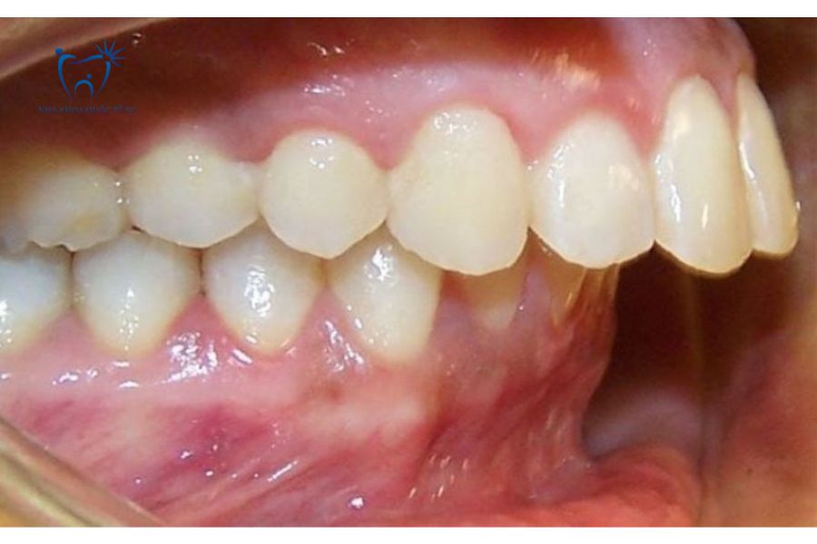 Tình trạng bệnh nhân bị hô răng cửa do xương hàm