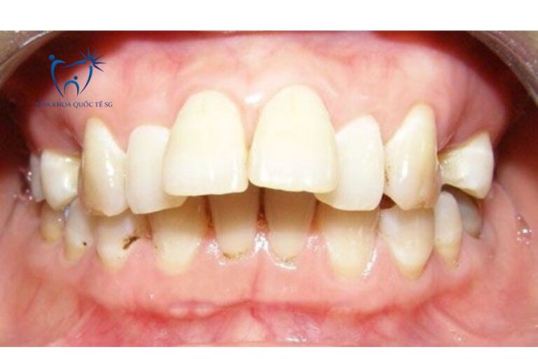 Tình trạng bệnh nhân bị hô răng cửa do răng