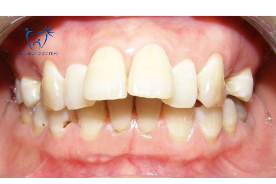 Tình trạng bệnh nhân bị hô răng cửa do răng