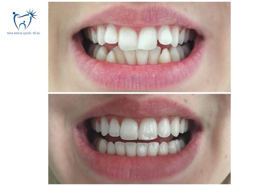 Bệnh nhân có răng khểnh nặng tuyệt đối không nên bọc sứ