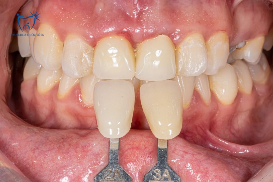 Nha Khoa Quốc Tế Sài Gòn Nghiên cứu kỹ lưỡng trước khi chọn màu cho răng cửa