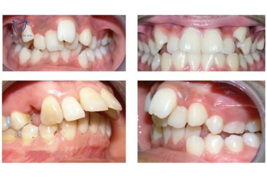 Bệnh nhân bị hô nặng không nên bọc sứ