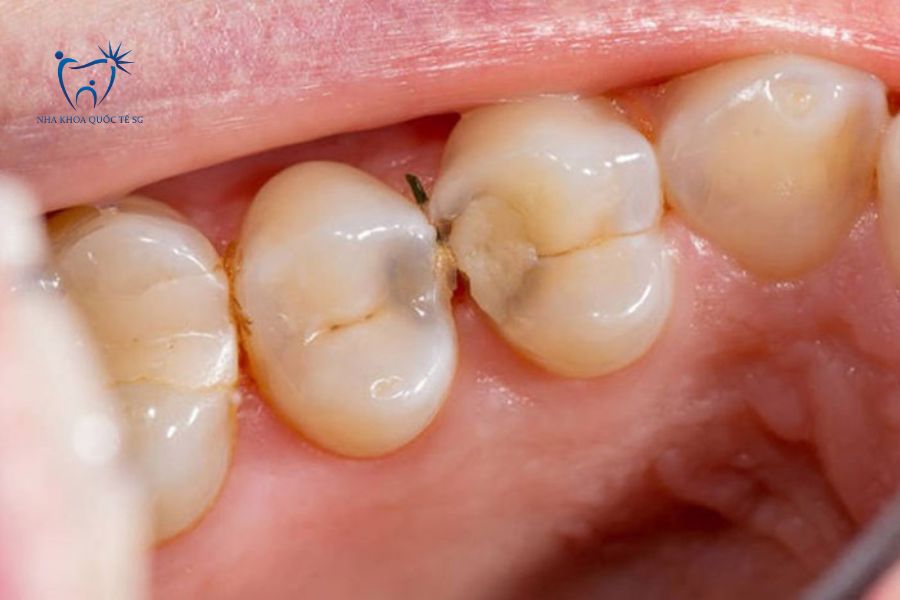 Bệnh nhân răng thưa dễ bị tình trạng sâu răng kẽ 
