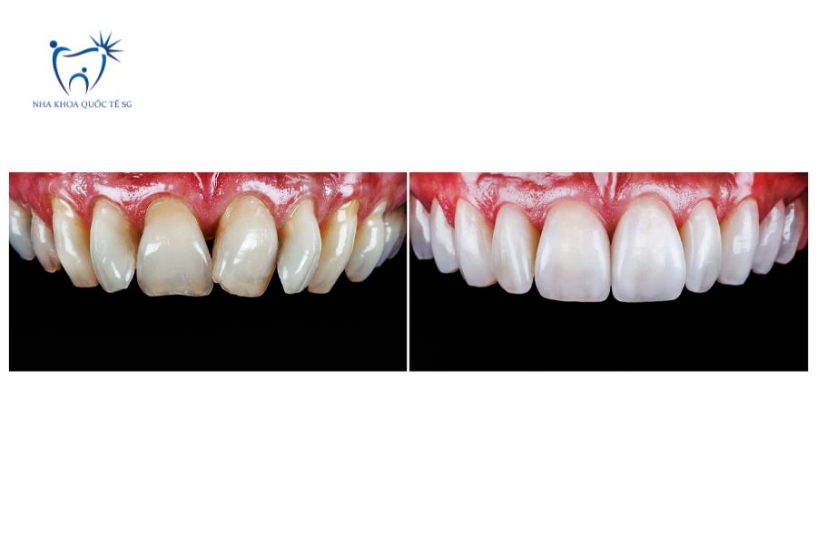 Tình trạng trước và sau khi dán Veneer răng cửa