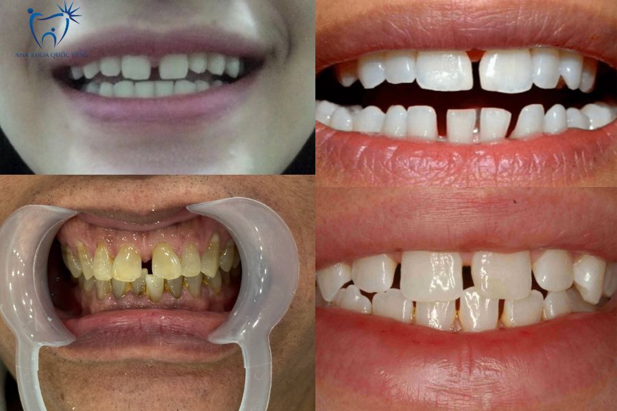 Các trường hợp răng thưa khác nhau