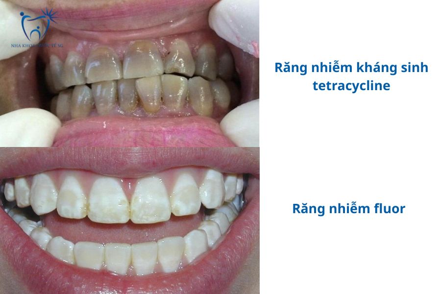 Nha Khoa Quốc Tế Sài Gòn Trường hợp răng bị nhiễm kháng sinh tetracycline và fluor