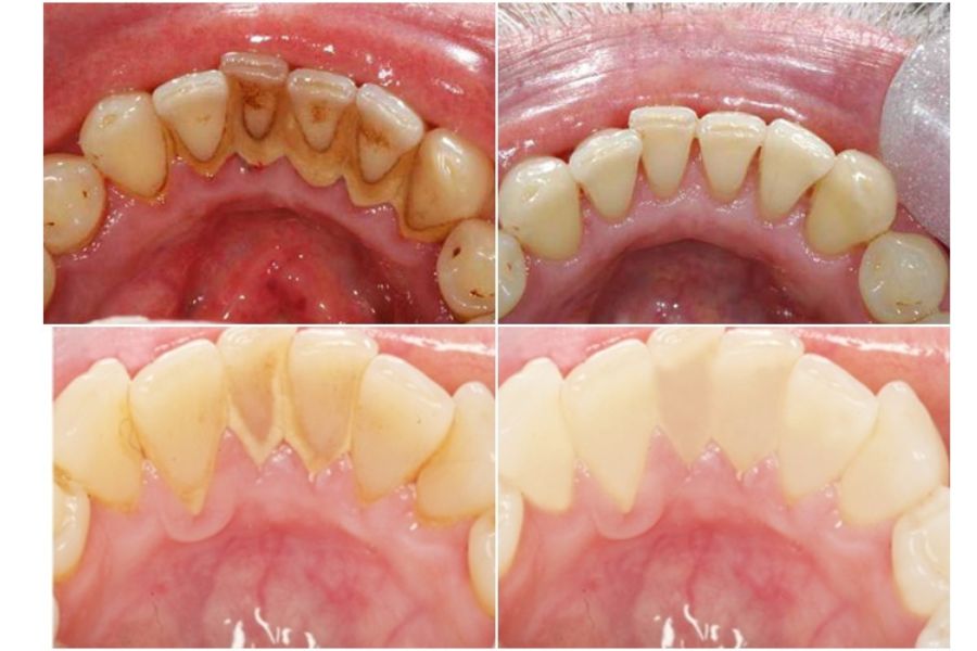 Hình ảnh trước và sau khi cạo vôi răng