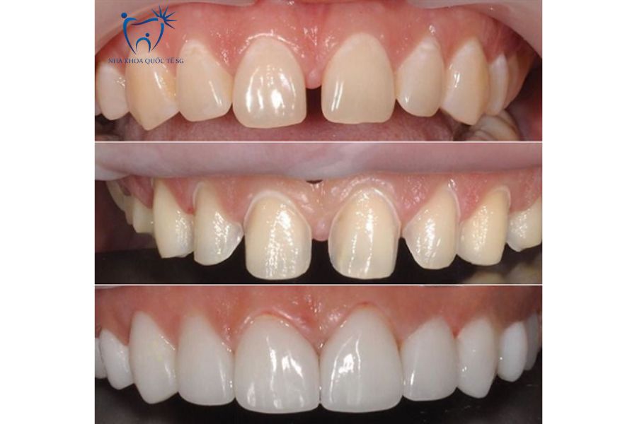 Bệnh nhân bọc sứ để khắc phục răng thưa