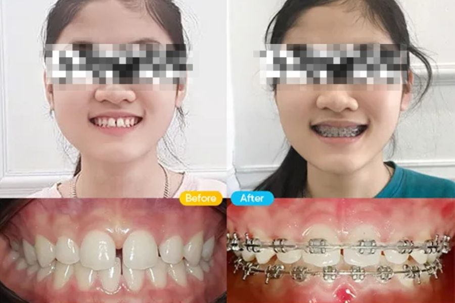 Bệnh nhân niềng răng để khắc phục răng thưa