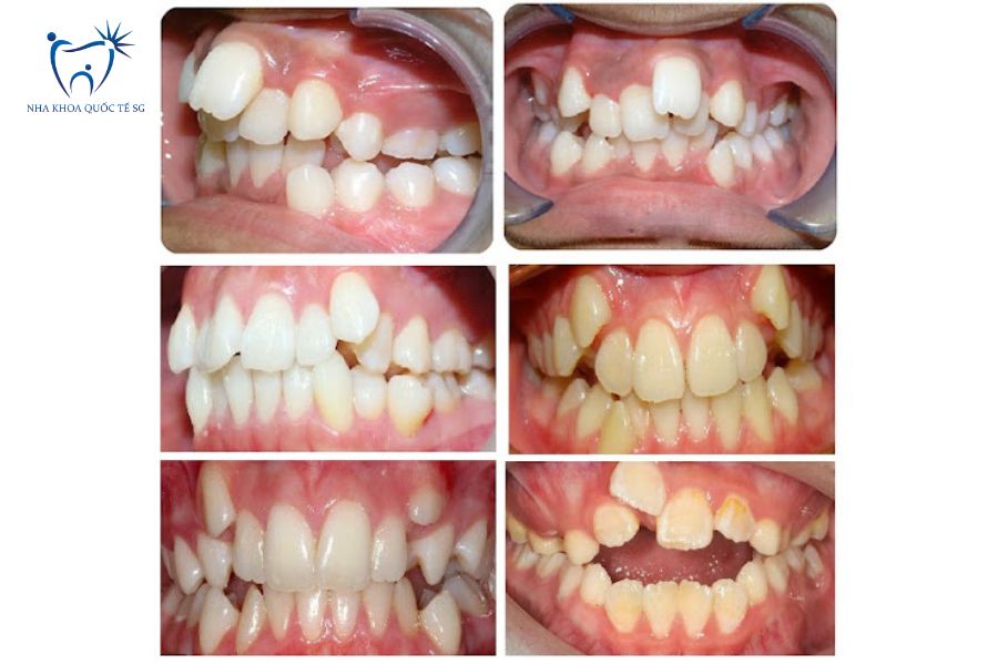 Tình trạng răng thưa, mọc lệch trầm trọng