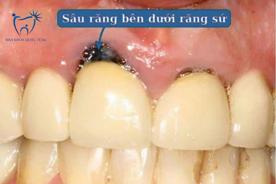 Tình trạng răng sâu tái phát dưới răng sứ