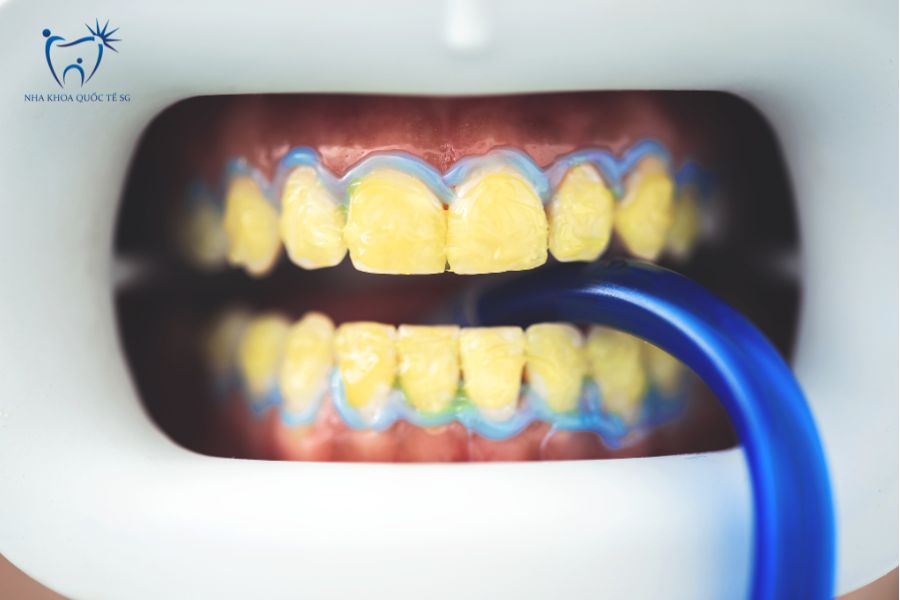 Mẹo làm trắng răng sứ bằng các phương pháp tại nhà