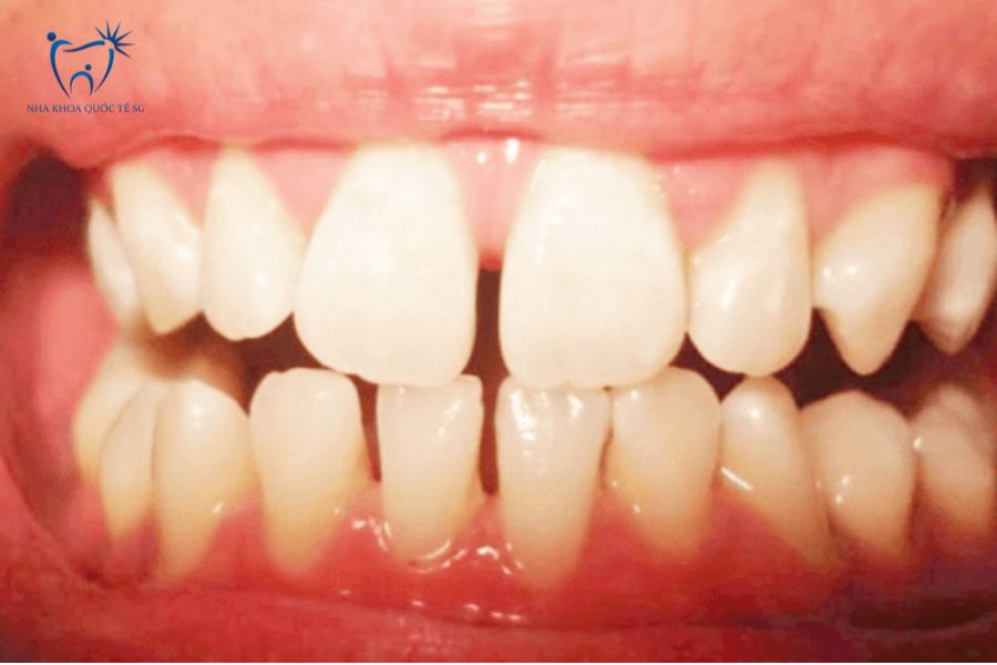 Phân cấp tình trạng răng thưa khác nhau