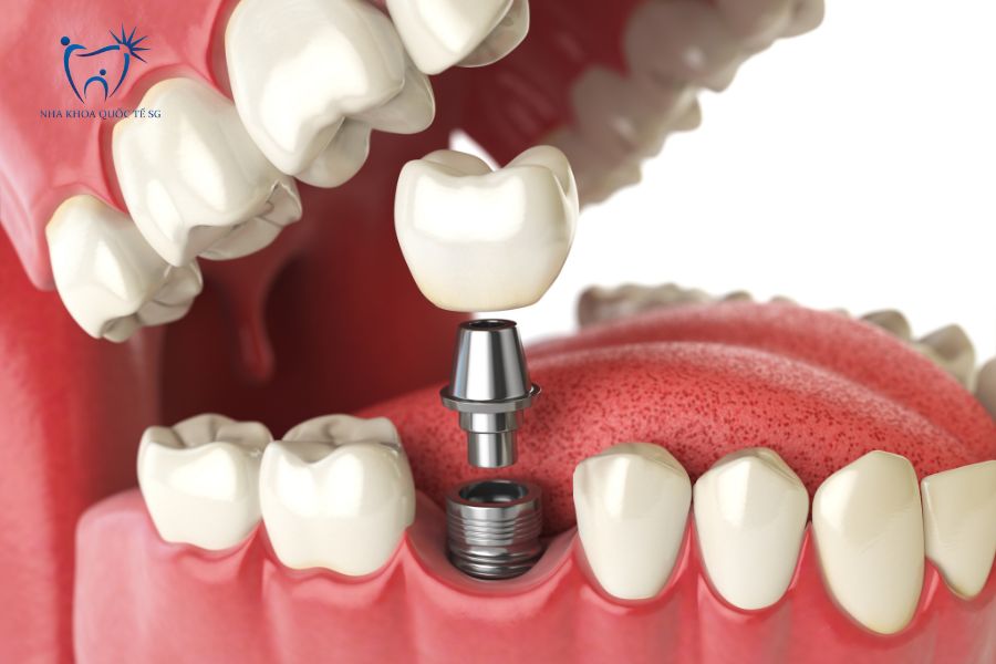Nha Khoa Quốc Tế Sài Gòn Cấu tạo Implant khi phục hình lên hàm răng