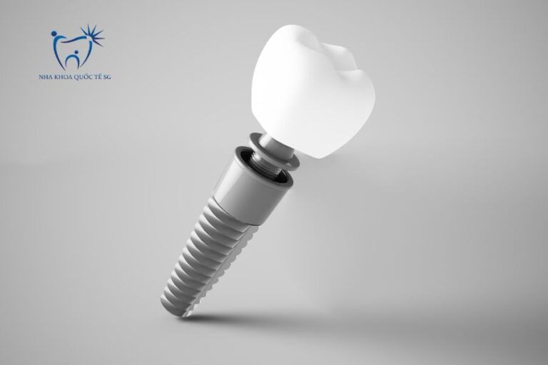 Mô hình mô phỏng Implant