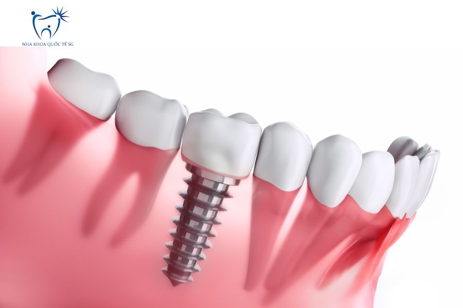 Nha Khoa Quốc Tế Sài Gòn Trồng răng sứ trên Implant không gây cảm giác đau