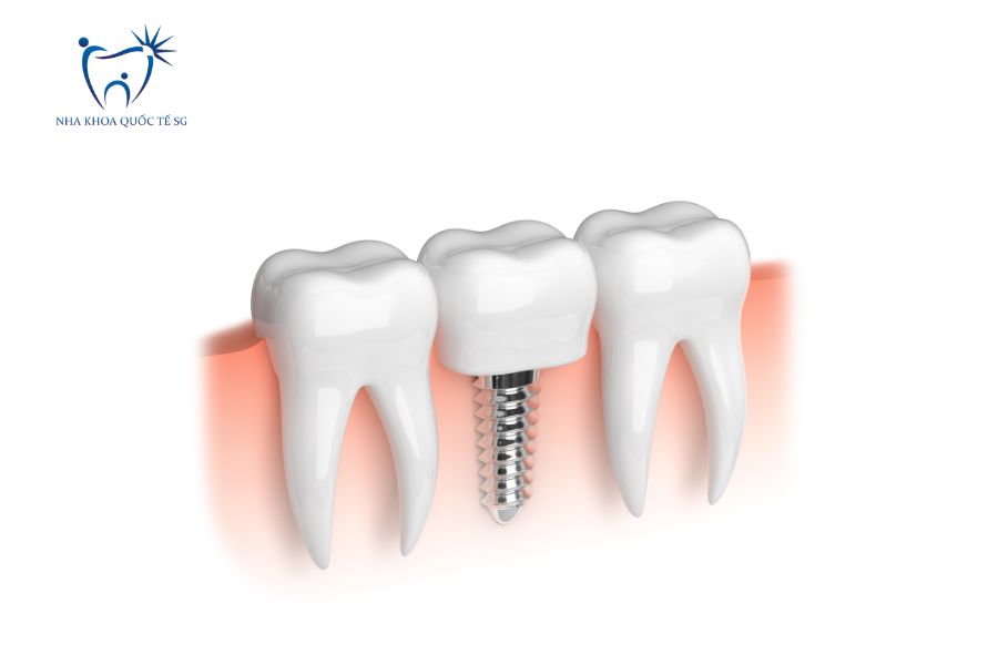 Nha Khoa Quốc Tế Sài Gòn Bác sĩ sẽ phục hình sứ trên Implant tùy vào từng trường hợp