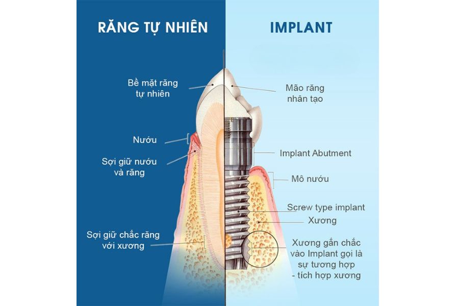 Nha Khoa Quốc Tế Sài Gòn So sánh cấu tạo Implant với răng tự nhiên