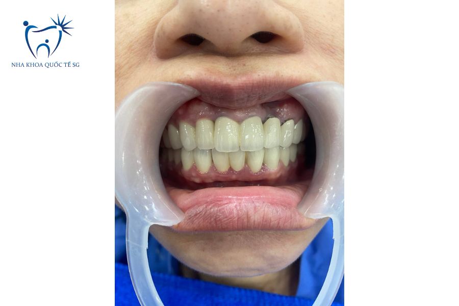 Tình trạng răng sứ kim loại bị đen viền nướu