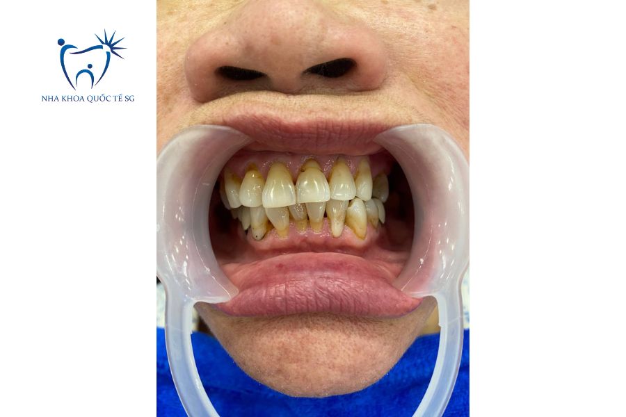 Tình trạng khách hàng bị tụt nướu