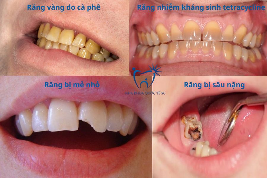 Nha Khoa Quốc Tế Sài Gòn Một số tình trạng răng miệng khác nhau