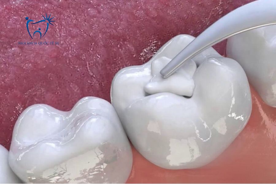 Xi măng nha khoa bị mòn theo thời gian